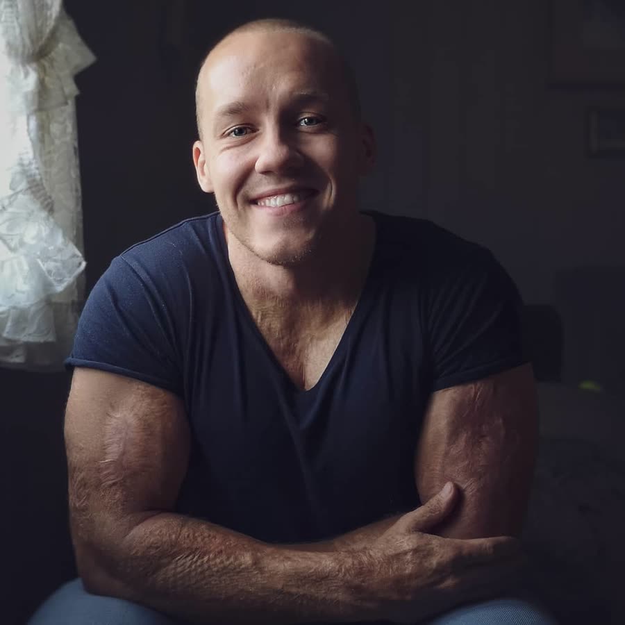 Simen sitter og smiler med armene i kryss – arrene etter brannskadene synes